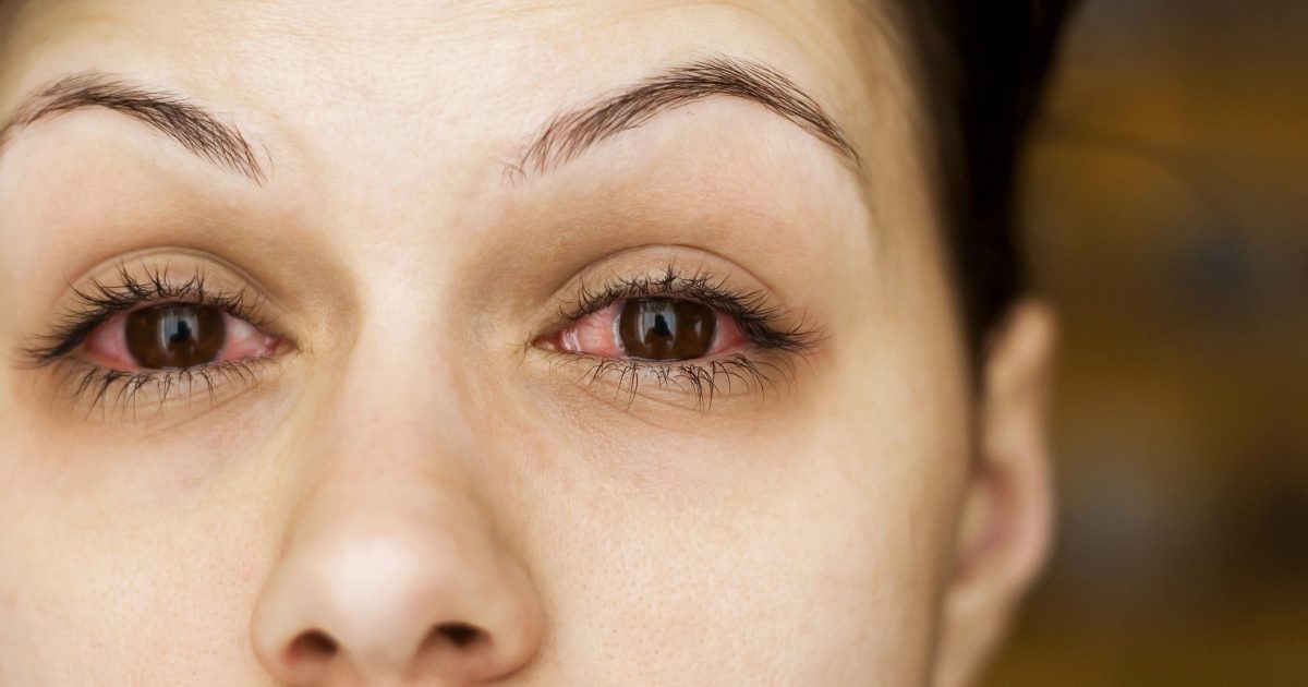 التهاب في المنزل العين علاج علاج التهاب
