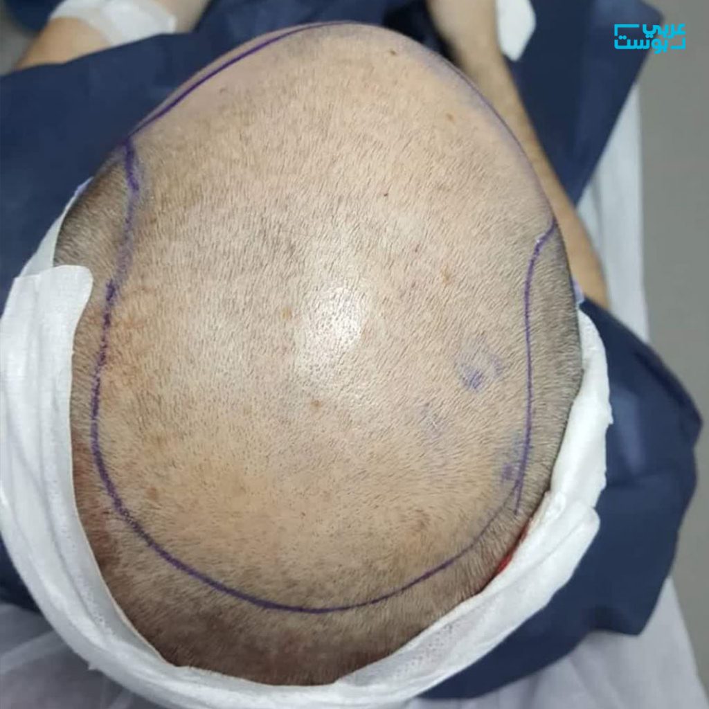 زراعة الشعر في تركيا