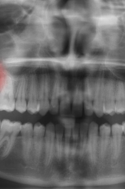 تكون أضراس العقل مائلة في الاتجاه بكثير من الأحيان، وهو ما يمكن أن يؤثر سلباً في بقية الأسنان/ istock