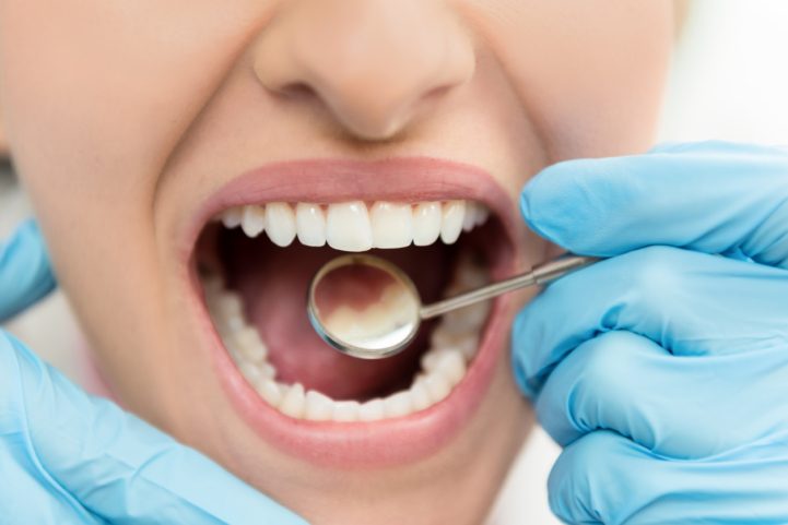 istock\ البقع على الأسنان