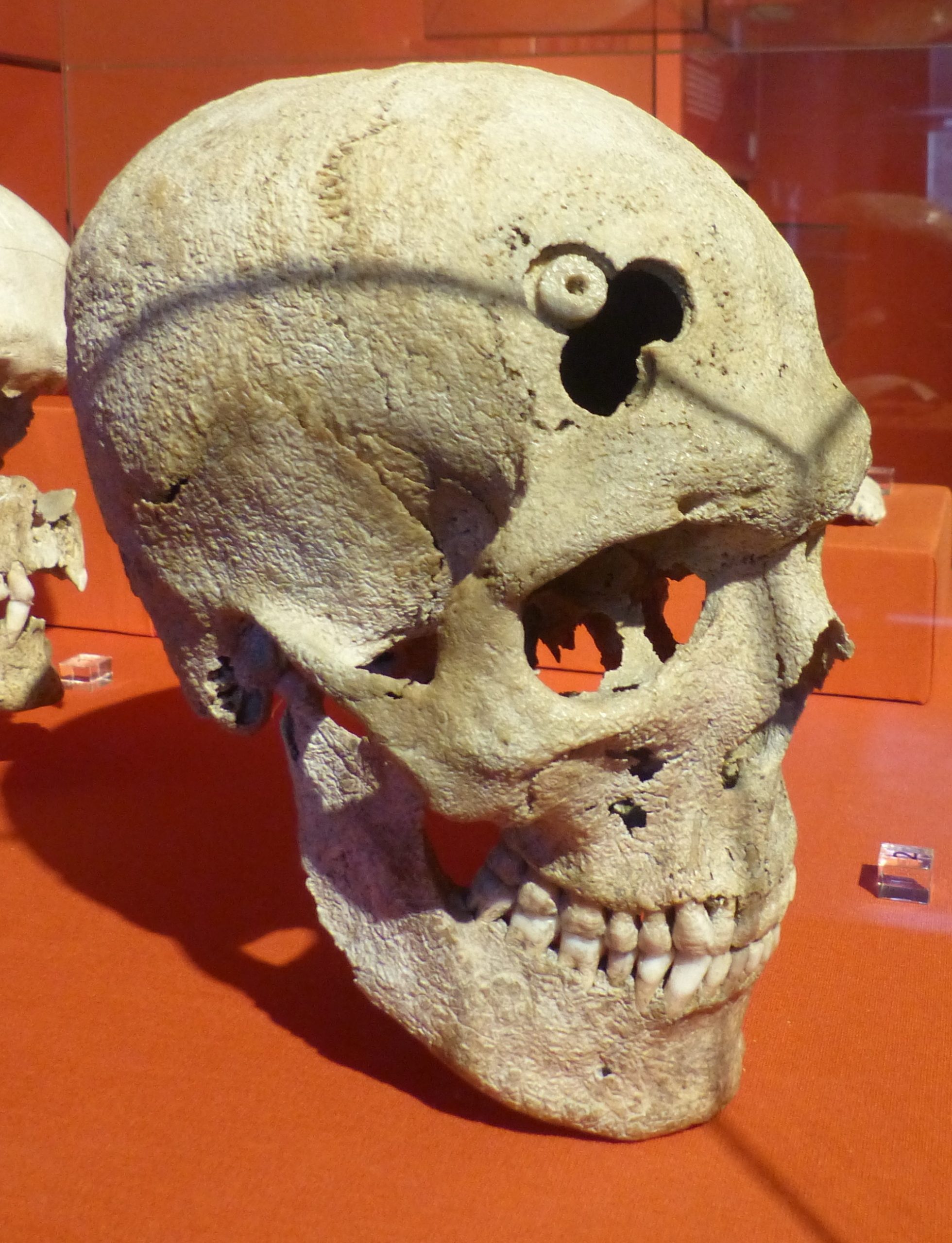 عملية ثقب الرأس كان يتم إجراؤها في مختلف الأماكن حول العالم في التاريخ القديم - WikiMedia
