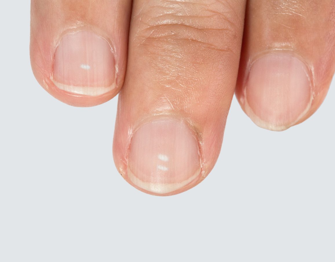 قد تسبب الأمراض الجلدية ظهور علامات بيضاء على الأظافر - iStock