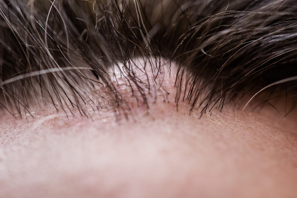 فروة الشعر هي المكان الأكثر إصابة بالأكياس الدهنية - iStock