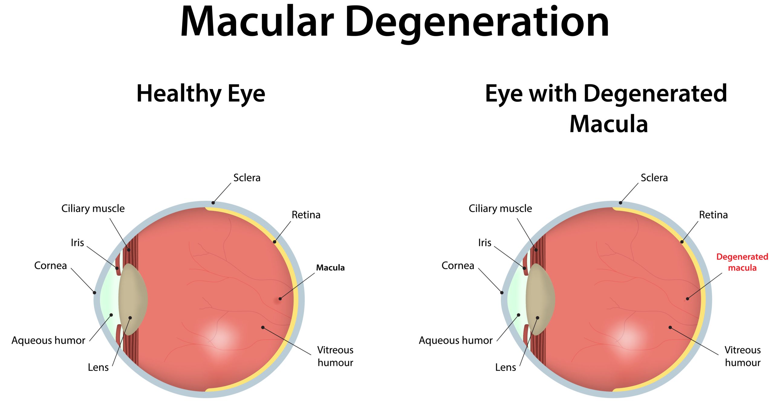 التغيرات الحاصة في العين بعد الإصابة بالتنكس البقعي|shutterstock