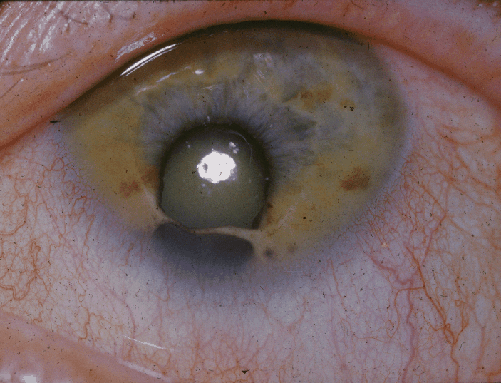 شكل العين بالنسبة للمصابين بمتلازمة عين القط|wikipedia