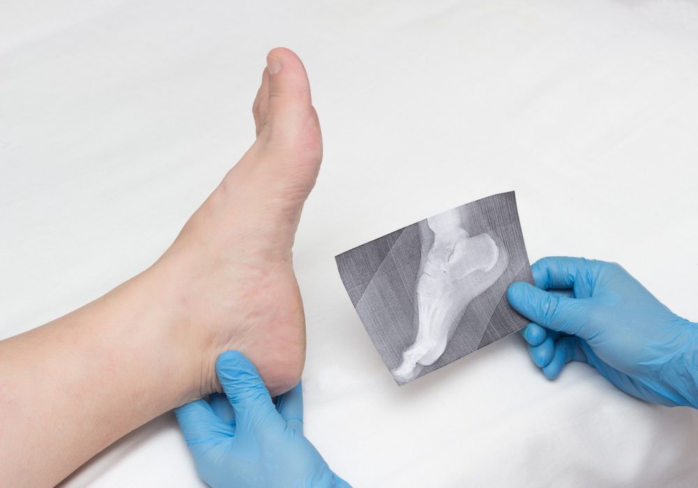 <strong>الأعراض الأساسية لالتهاب اللفافة الأخمصية </strong>/ shutterstock 